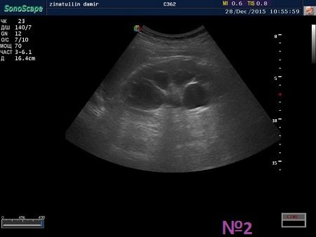 УЗи2 Почка.jpg