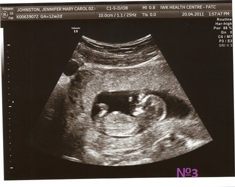 Узи3 бер12нед.jpg