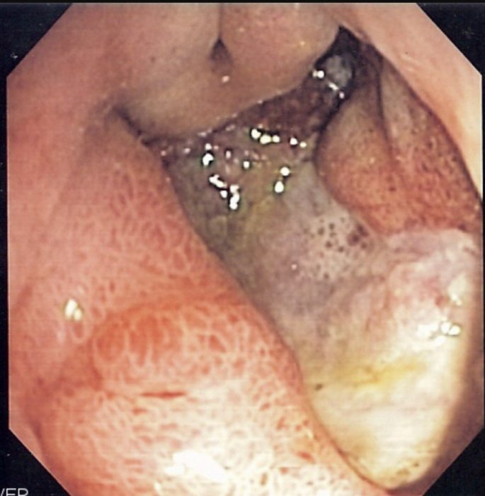 Язва желудка_Здоровье.jpg