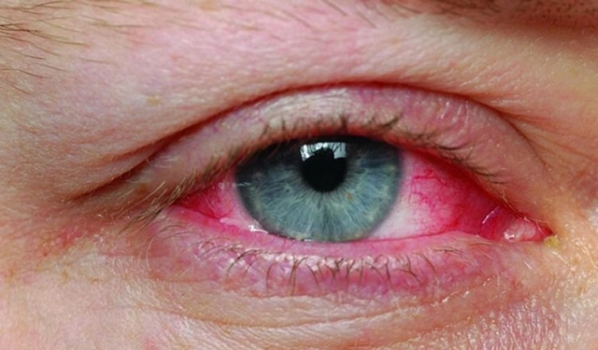 глаз коньнктивит.jpg