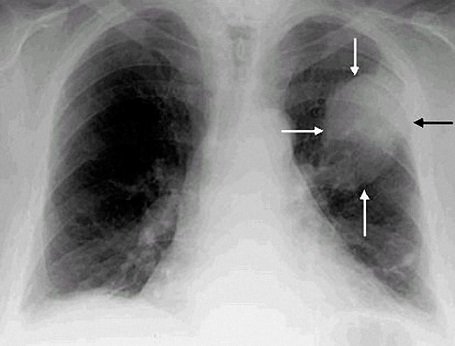 lung-cancer-2.jpg